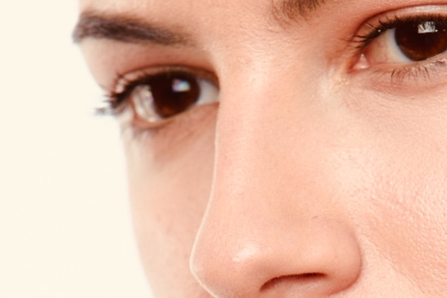 Xanthelasma removal surgically/using laser