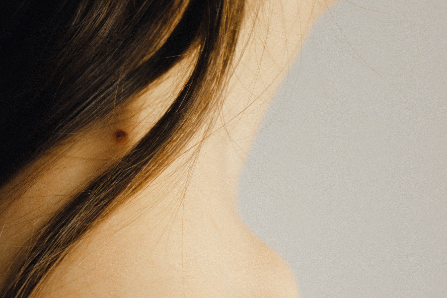 Birthmark removal – treatment at Moser Milani Medical Spa in Vienna