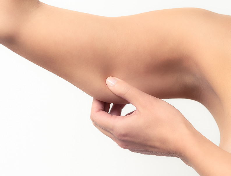 Upper arm lift – treatment at Moser Milani Medical Spa in Vienna