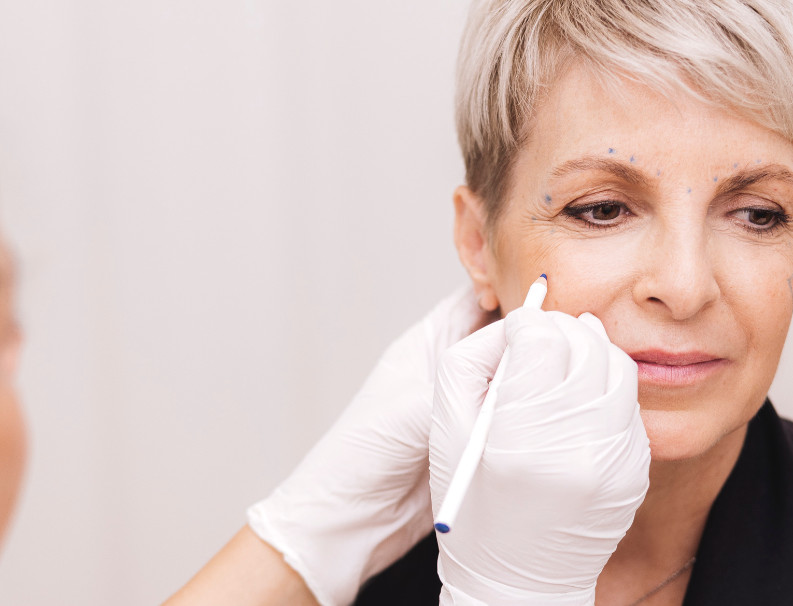 Cheek reconstruction with hyaluronic acid