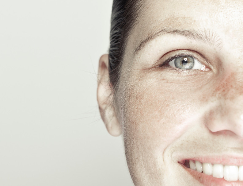 Pigment peeling treatment (Cosmelan) – treatment at Moser Milani Medical Spa in Vienna