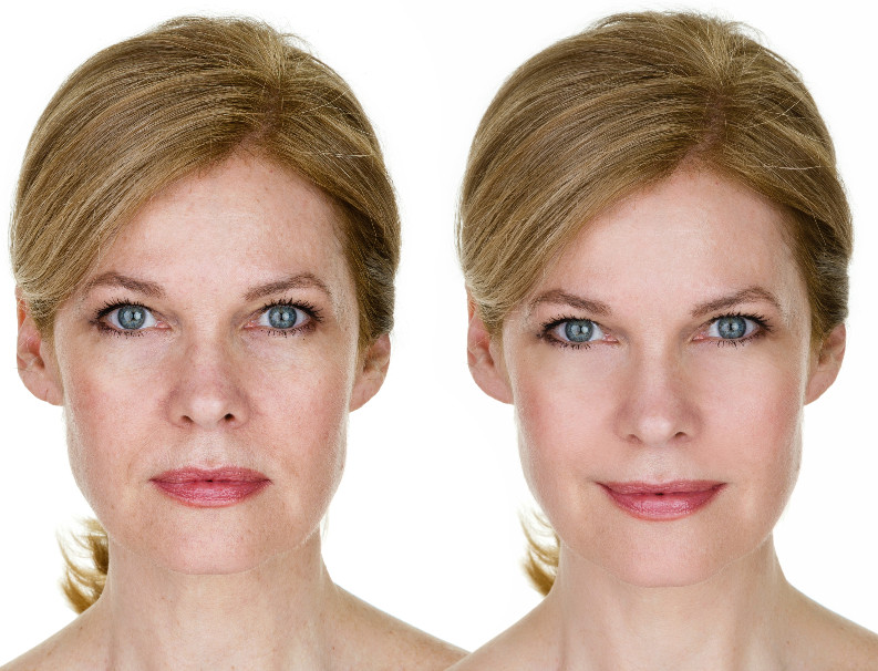 Strengthen facial contours