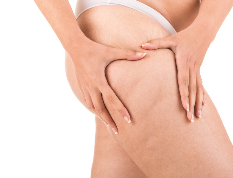Connective tissue weakness