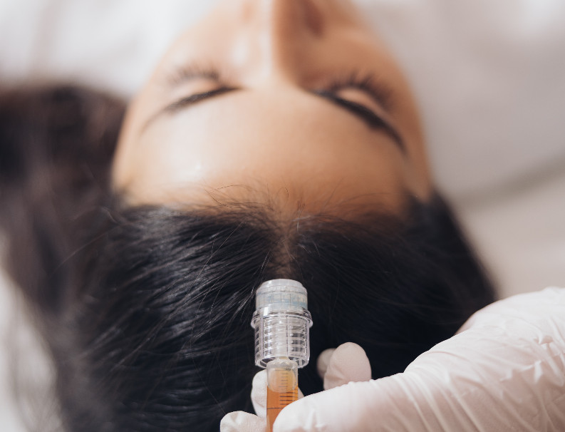 Mesohair treatment – treatment at Moser Milani Medical Spa in Vienna