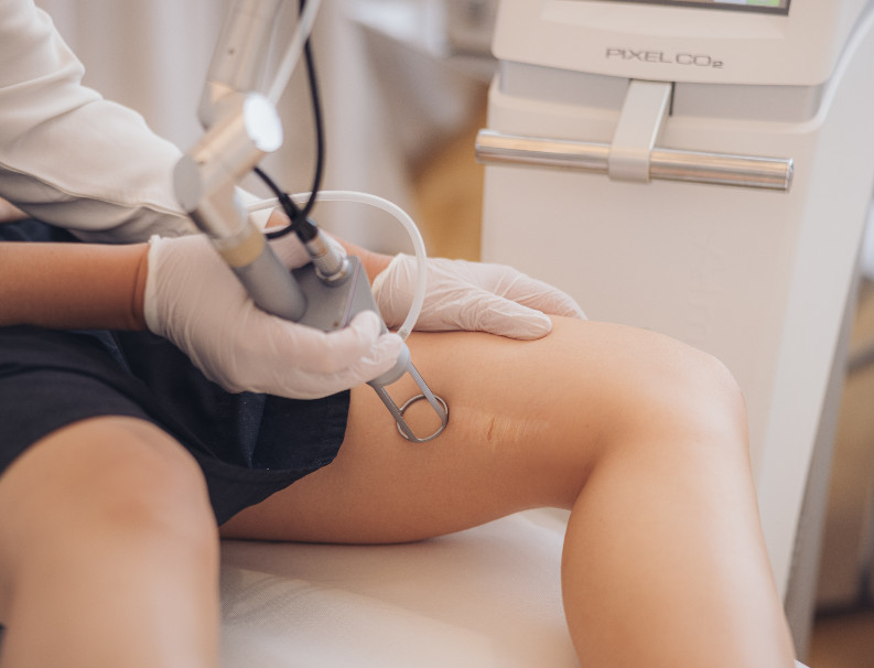Laser treatment of scars and stretch marks using CO2 – treatment at Moser Milani Medical Spa in Vienna