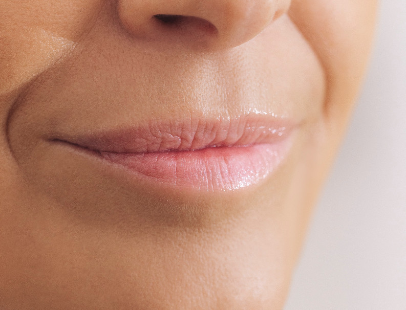 Flip lip – treatment at Moser Milani Medical Spa in Vienna