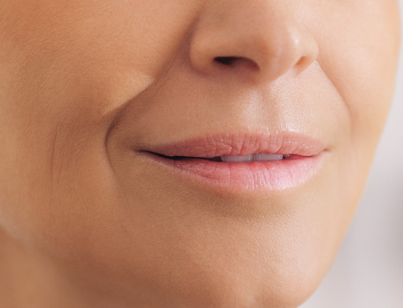 Plissé lines (lip lines, barcode lines, or smoker's lines)